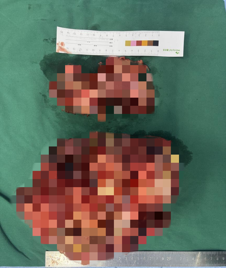 切除的瘤体最大直径约24cm。