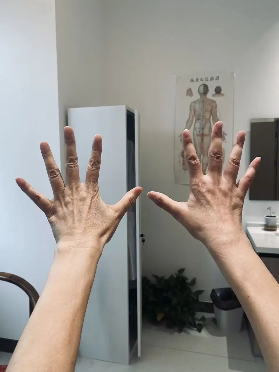 目前，王女士右手基本恢复了功能。